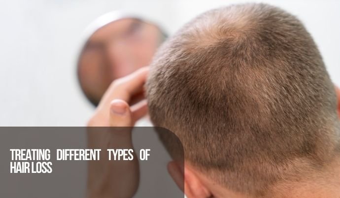 Treating Different types of hair loss