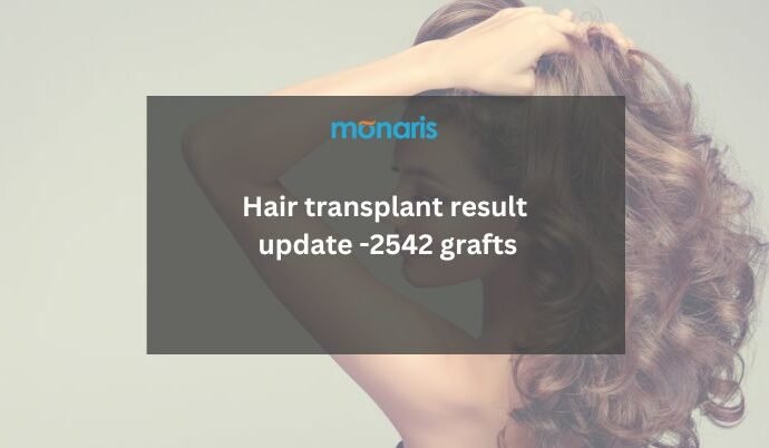 hair transplant result update -2542 grafts