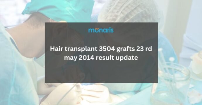 Hair transplant 3504 grafts 23 rd may 2014 result update