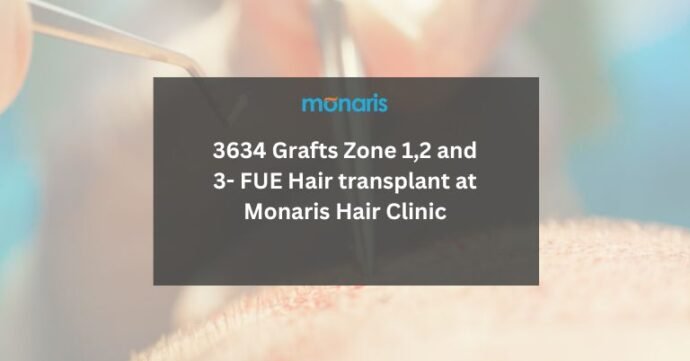 3634 Grafts Zone 1,2 and 3- FUE Hair transplant at Monaris Hair Clinic