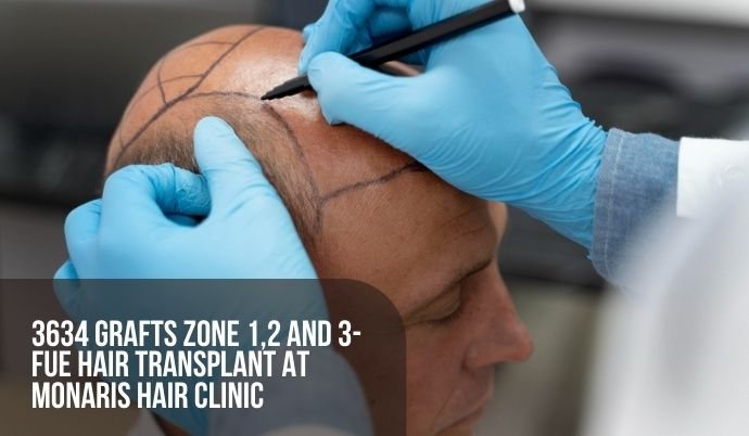 3634 Grafts Zone 1,2 and 3- FUE Hair transplant at Monaris Hair Clinic