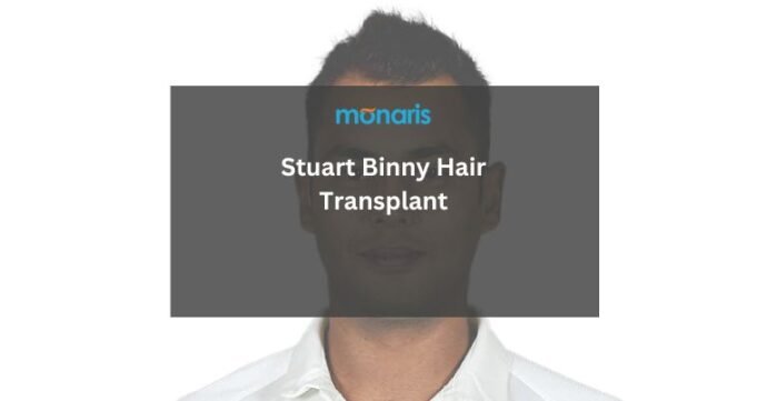 Stuart Binny Hair Transplant
