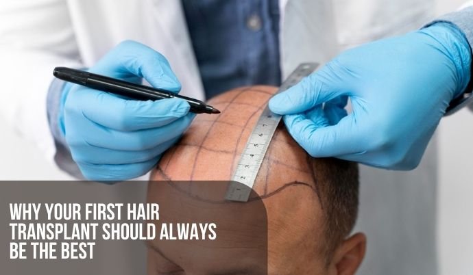 Why Your First hair transplant should always be the Best