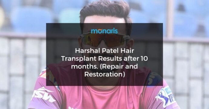 Harshal Patel Hair Transplant Results after 10 months. (Repair and Restoration)