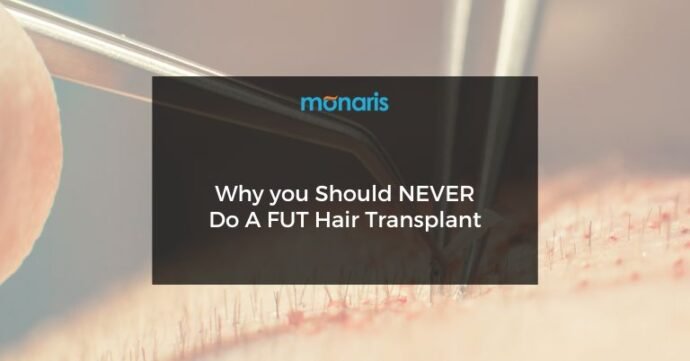 Why you Should NEVER Do A FUT Hair Transplant