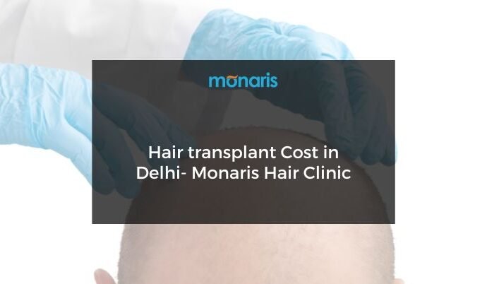 Hair transplant Cost in Delhi- Monaris Hair Clinic