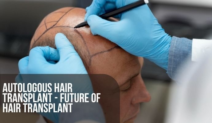 Autologous Hair Transplant - Future of Hair Transplant